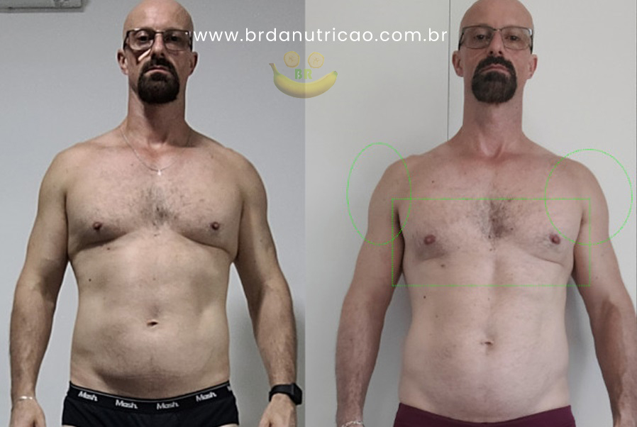 jucemar lipomastia tratamento