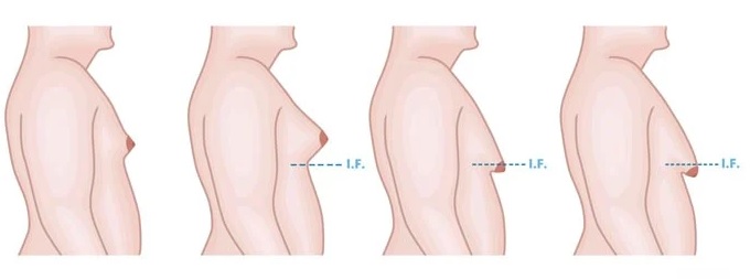 grau de ginecomastia
